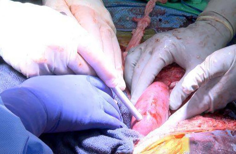 美国完成世界首例猪肾移植手术，在脑死亡病人身上实验
